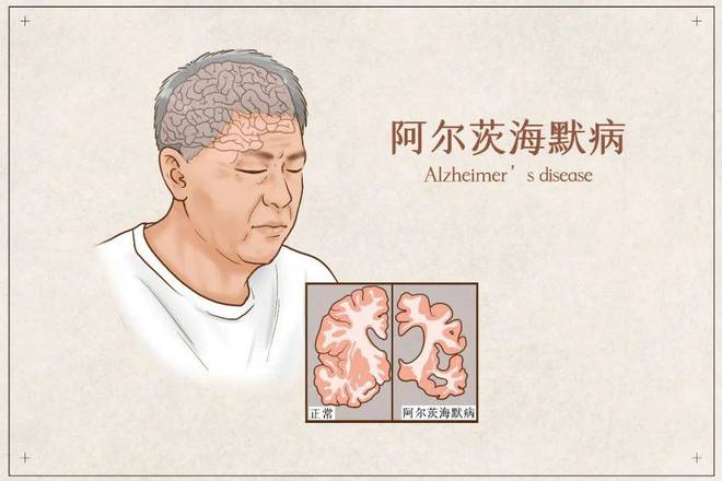 老年记忆力减退非小事五开云大原因需警惕！